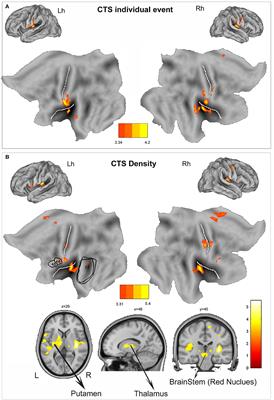 Mapping the Effect of Interictal Epileptic Activity Density During Wakefulness on Brain Functioning in Focal Childhood Epilepsies With Centrotemporal Spikes